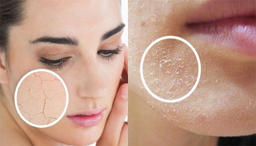 Kem Dưỡng ẩm nào phù hợp với làn da bị khô và nứt nẻ.