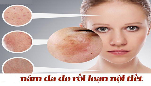 Điều trị nám da hiệu quả