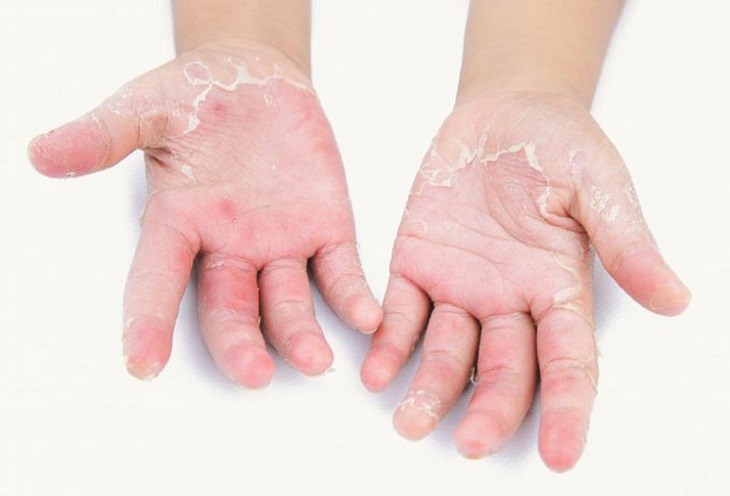 Cách điều trị da bị á sừng