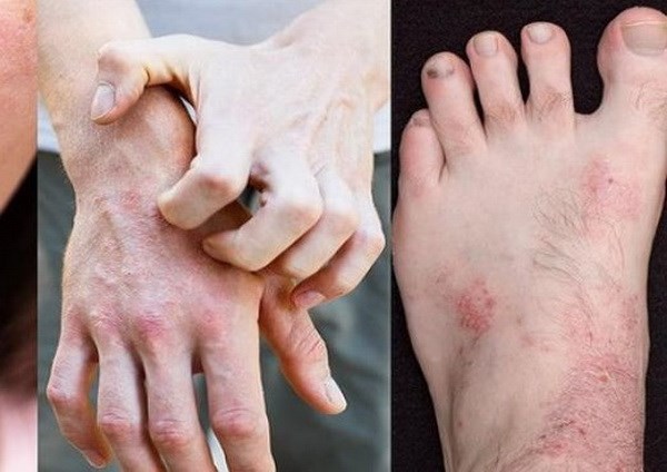 Lựa chọn đúng thuốc trị viêm da cơ địa