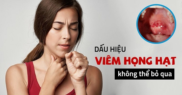 Bệnh viêm họng hạt và các cách chữa cực dễ tại nhà
