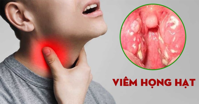 Viêm họng hạt - Có trị dứt điểm được không?