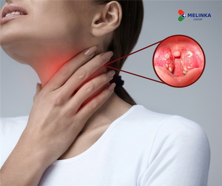 Viêm họng nên ăn gì hoặc kiêng ăn gì để mau khỏi bệnh?