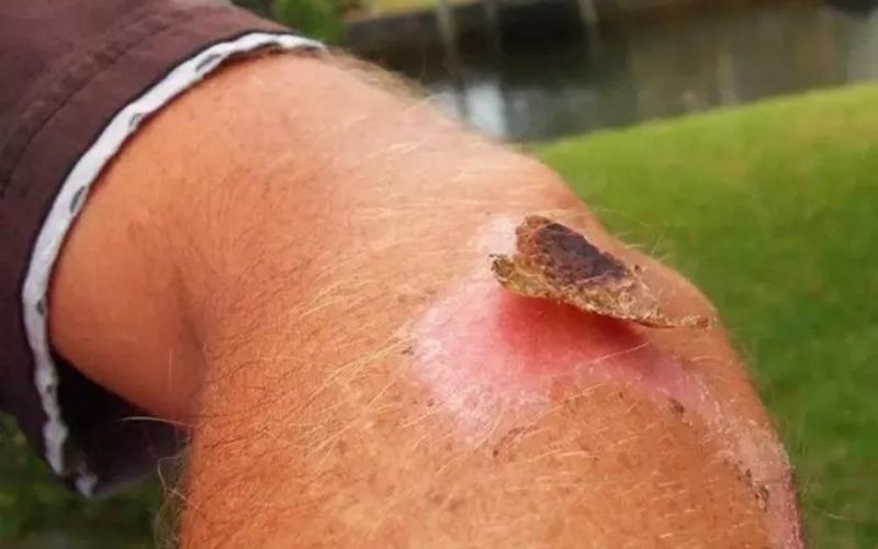 Vết thương lên da non cần làm gì để nhanh lành?