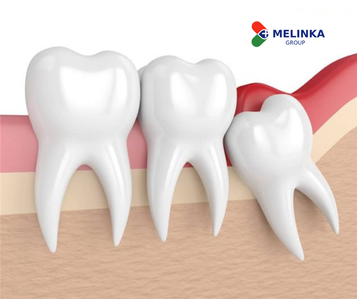 Nguy hiểm khôn lường nếu nhổ răng khôn không đúng cách