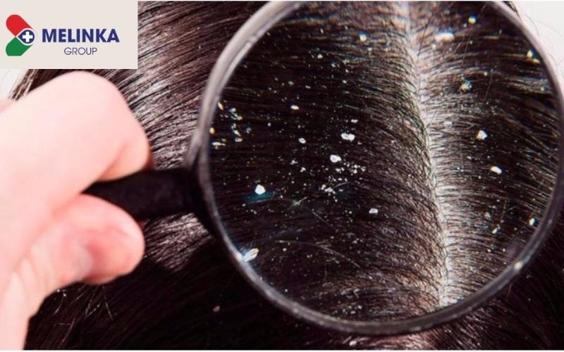 Tại sao dùng dầu gội trị gàu nhưng vẫn nhiều gàu?