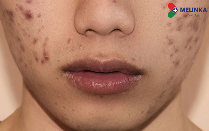 Các cách loại bỏ thâm mụn ngay tại nhà 