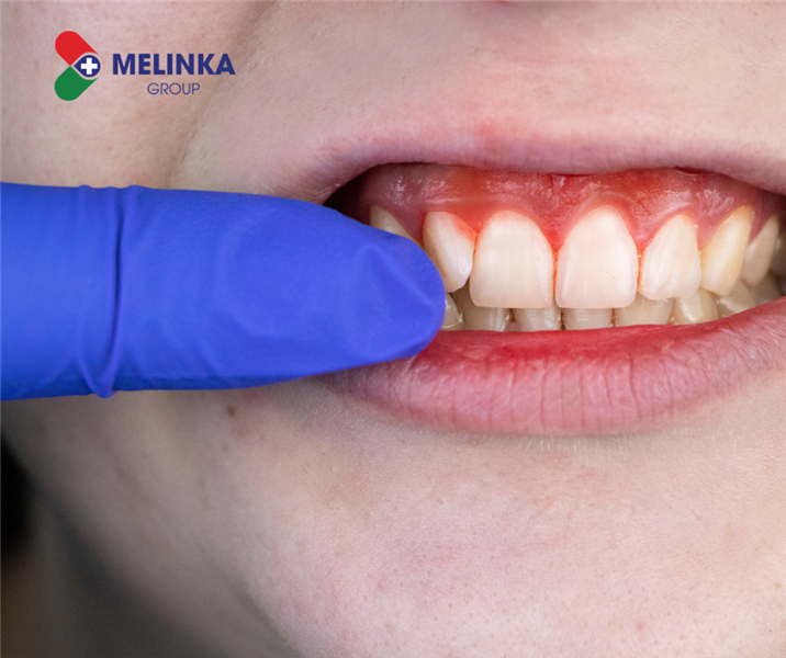 Phải làm sao khi con bị viêm lợi?