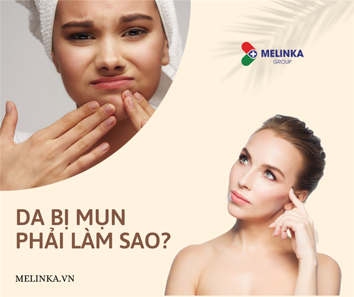 Da mặt bị mụn - Làm cách nào để cải thiện?