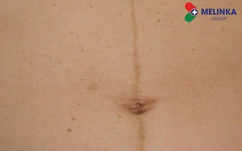 Xuất hiện đường sọc nâu trên bụng dù không mang thai