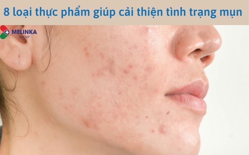 8 loại thực phẩm giúp cải thiện mụn