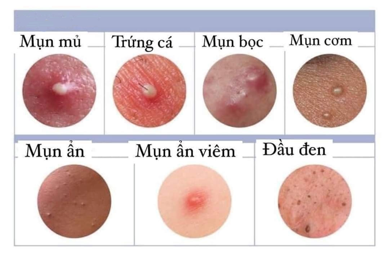 Điểm danh 05 loại mụn trứng cá ai cũng cần biết