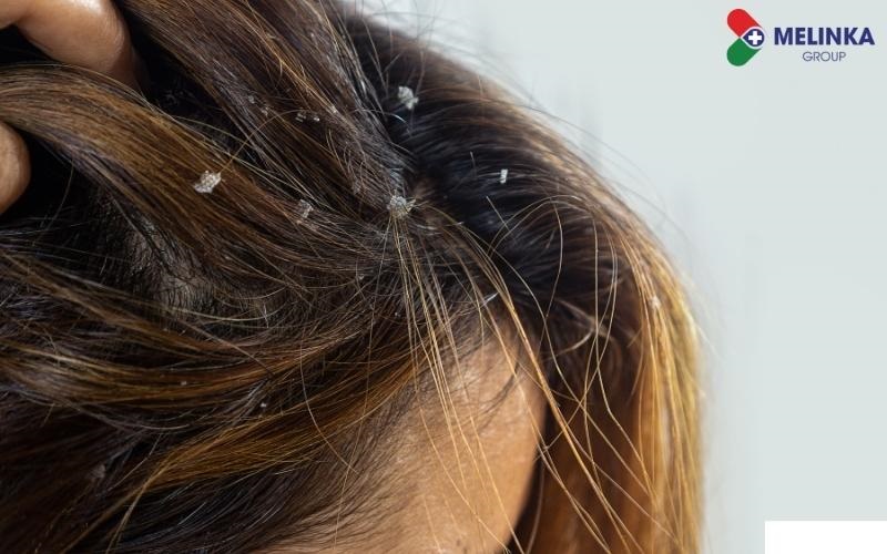 Gàu - Nỗi ám ảnh không của riêng ai