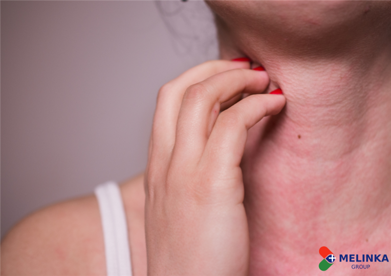 8 NGUYÊN NHÂN NỔI MỀ ĐAY PHỔ BIẾN CÓ THỂ BẠN CHƯA BIẾT