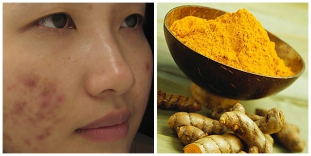 BÔI NGHỆ TƯƠI CÓ HẾT SẸO KHÔNG ·