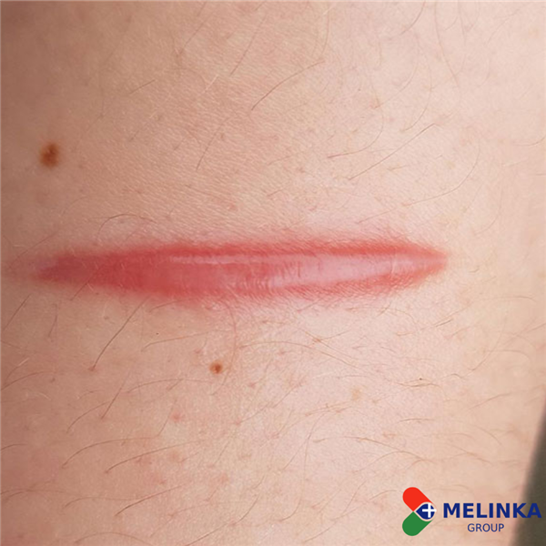 7 CÁCH GIÚP MỜ SẸO TẠI NHÀ TỪ THIÊN NHIÊN HIỆU QUẢ