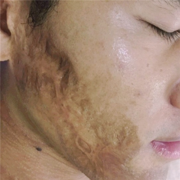 MÁCH BẠN CÁCH TRỊ SẸO LÂU NĂM KHÔNG PHẢI AI CŨNG BIẾT