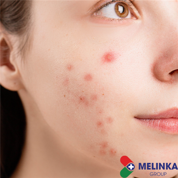 MỘT SỐ LƯU Ý KHI SỬ DỤNG KEM NGHỆ BẠN NÊN BIẾT