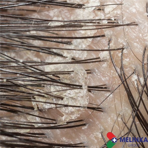 GÀU SINH RA  TỪ ĐÂU? TẠI SAO LẠI CÓ GÀU?