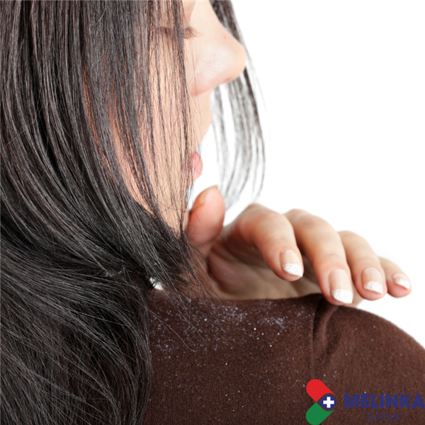 TOP 5 CÁCH ĐIỀU TRỊ DỨT ĐIỂM GÀU TẠI NHÀ