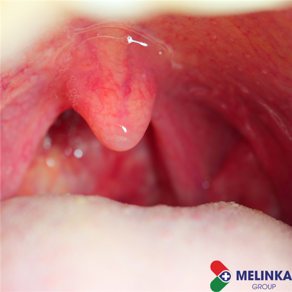 VIÊM AMIDAN: TRIỆU CHỨNG, PHÂN LOẠI VÀ CÁCH ĐIỀU TRỊ