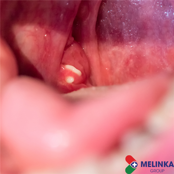 VIÊM HỌNG - KHI NÀO THÌ NGUY HIỂM? 