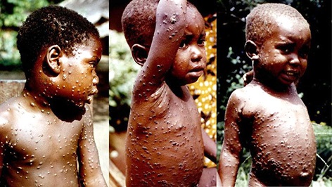 BỆNH ĐẬU MÙA KHỈ LÂY QUA ĐƯỜNG NÀO?