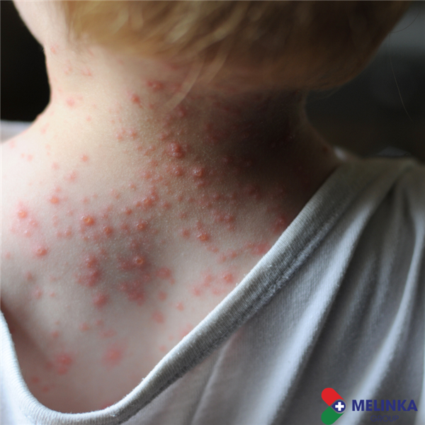 CÓ ĐƯỢC CHÍCH NGỪA ĐẬU MÙA ĐỂ PHÒNG ĐẬU MÙA KHỈ?