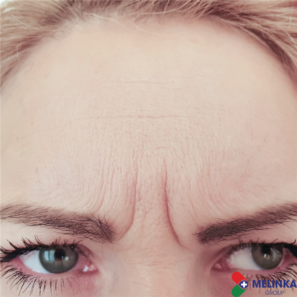 BÍ KÍP XOÁ NẾP NHẮN ĐƠN GIẢN, NHANH CHÓNG