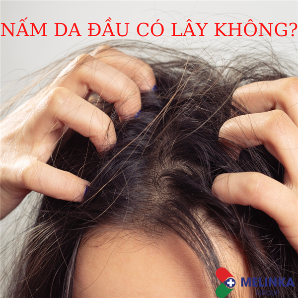 NẤM DA ĐẦU CÓ LÂY KHÔNG?