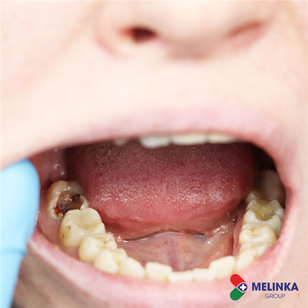 TÁC DỤNG CỦA NƯỚC SÚC MIỆNG LÀ GÌ?